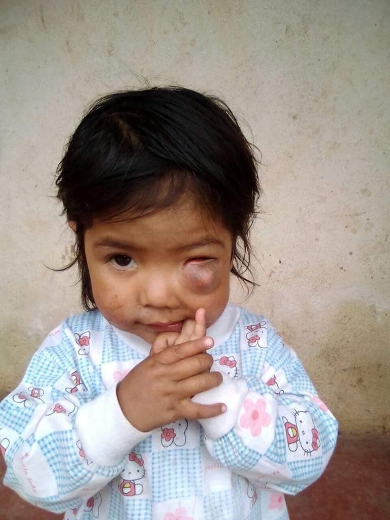 Kleines Kind mit einem blauen Auge, das die Hand hochhält, trägt ein hellblau-rosa gemustertes Hemd.