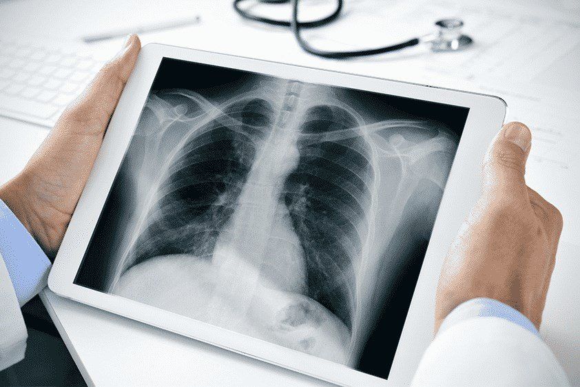 fibrose-pulmonar