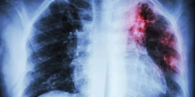 Uma radiografia dos pulmões de uma pessoa com uma mancha vermelha no lado direito.