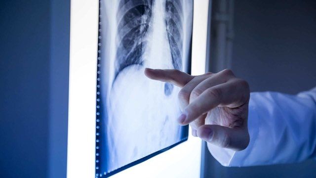 Um médico está apontando para uma radiografia do tórax de uma pessoa.