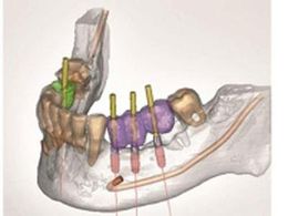 Dental implant scheme