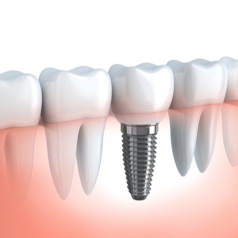 figura di un impianto dentale