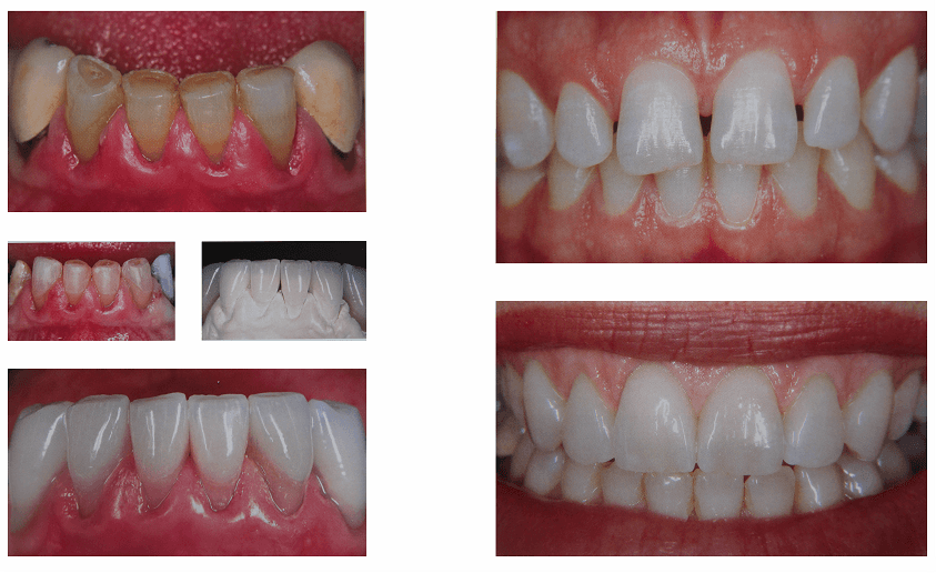 dental aesthetics