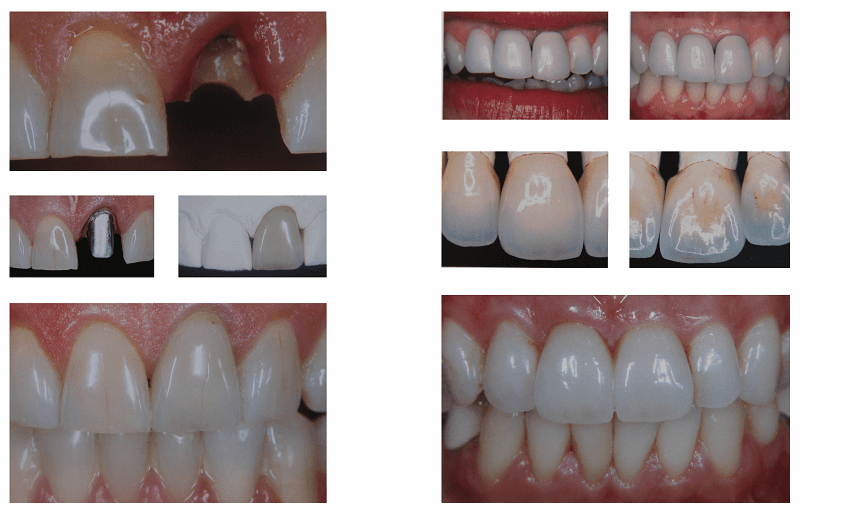 dental aesthetics