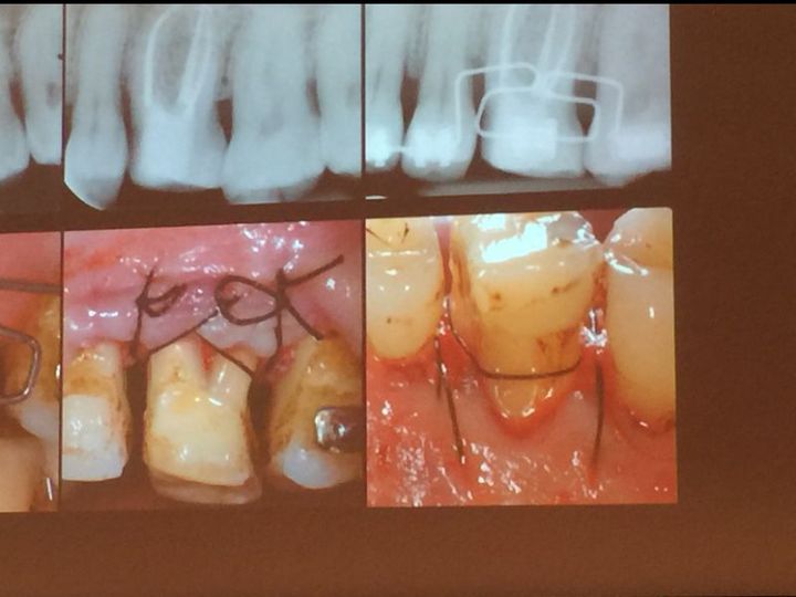 Trattamento laser estetica dentale