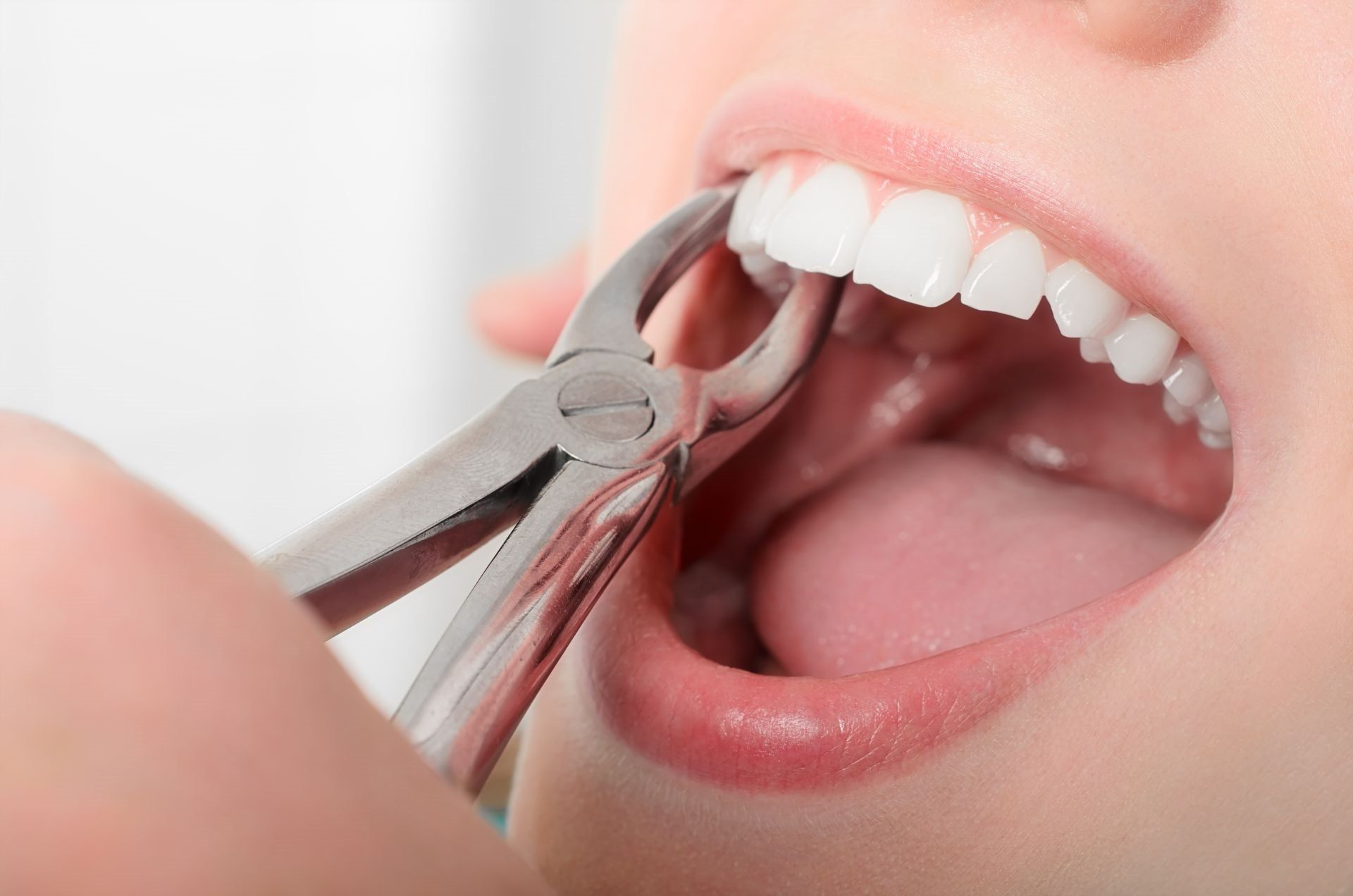 Tooth extraction