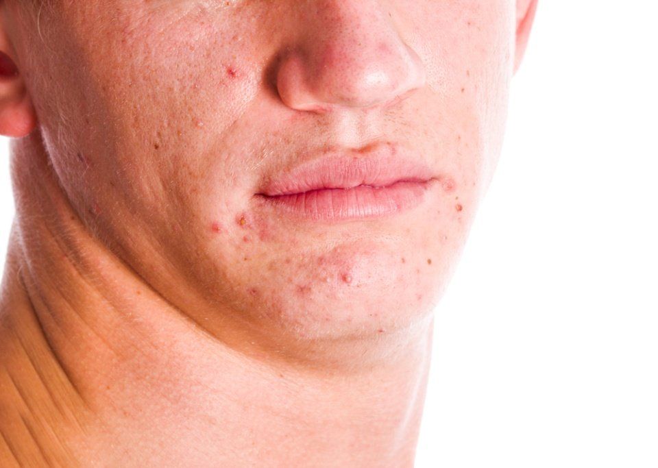trattamento con laser
