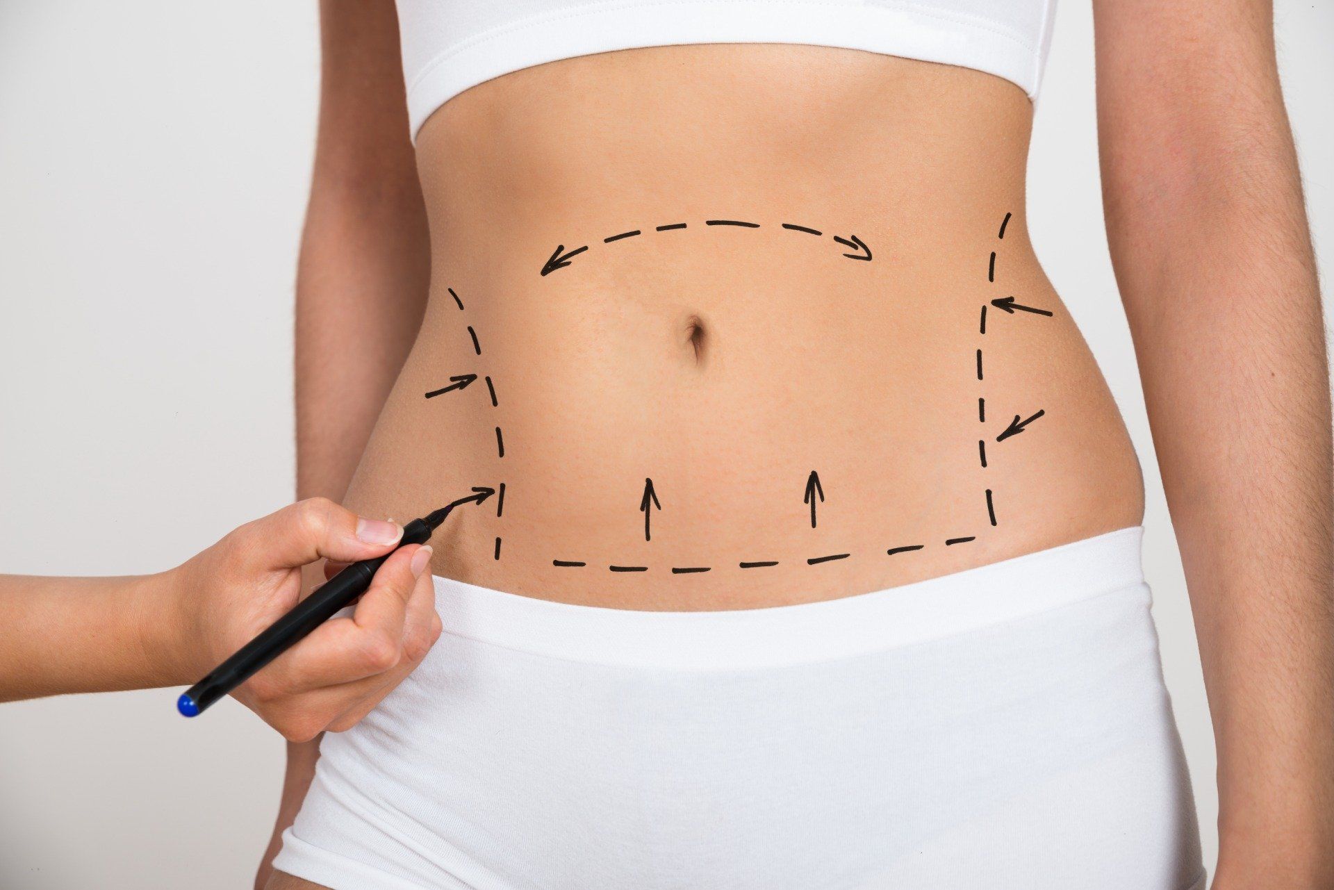 segni sul ventre per liposuzione