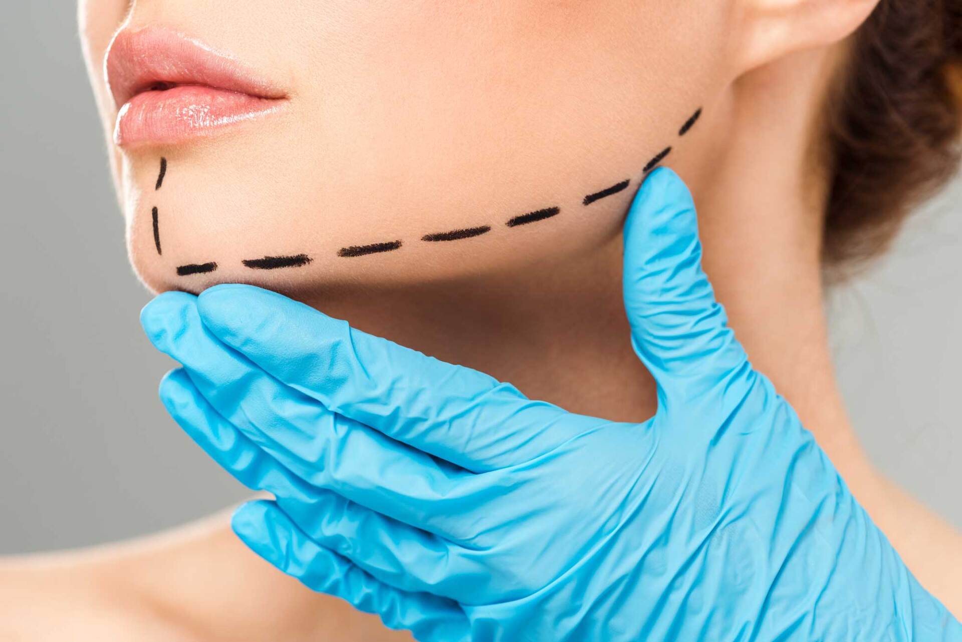 segni sul mento per mentoplastica
