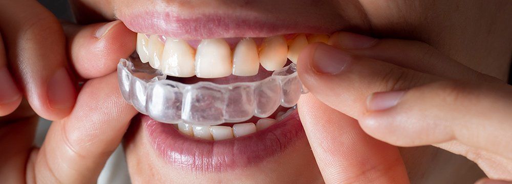 invisalign aligner in mouth