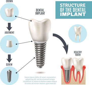 Dental implant - Periodontist in Vineland, NJ Dental implant - Periodontist in Vineland, NJ