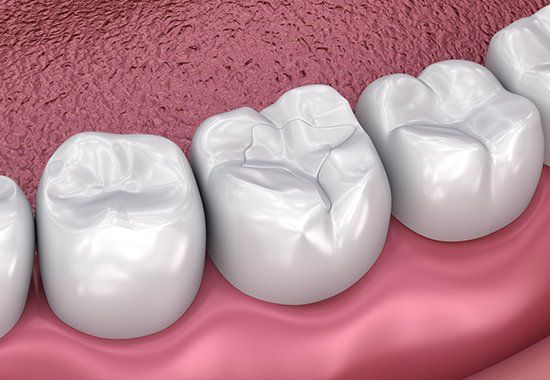 Teeth with Sealant — Colorado Springs, CO — Smile Heart Dental Hygiene Teeth with Sealant — Colorado Springs, CO — Smile Heart Dental Hygiene