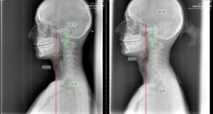 A couple of x-rays of a person 's head and neck.