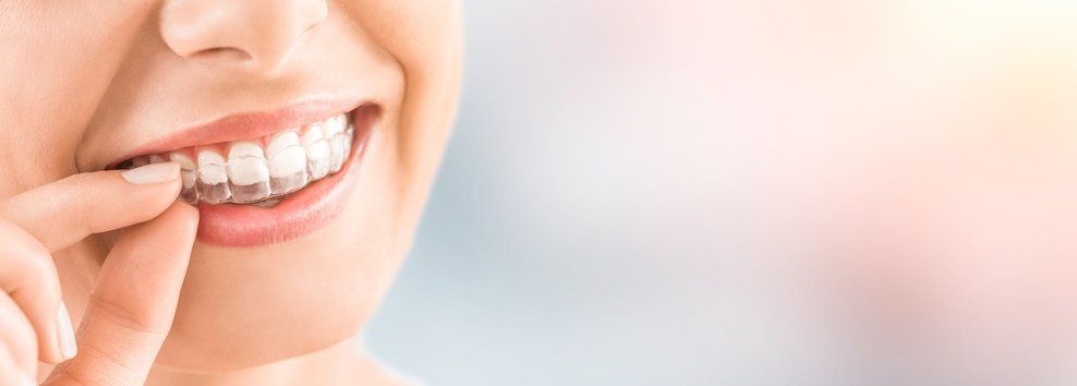 View the Top 5 Reasons to Consider Invisalign Clear Braces for Your Teen!
