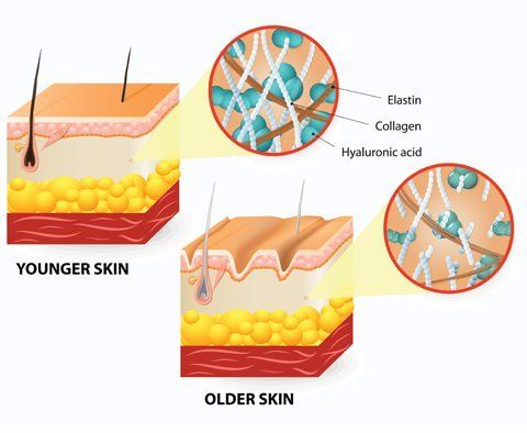 Hyaluronic Acid Injections