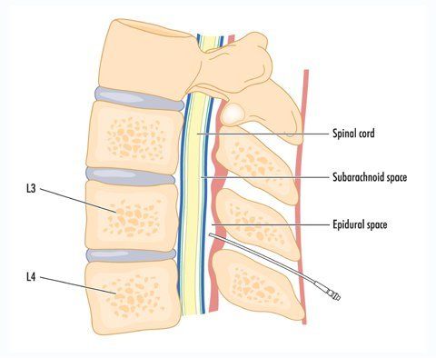 Epidural Steroid Injections