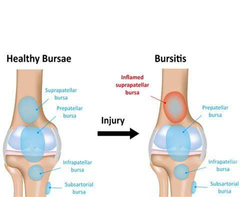 Symptoms of Tendinitis and Bursitis Symptoms of Tendinitis and Bursitis
