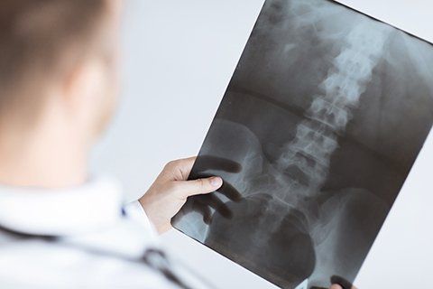 Thoracoscopic Release