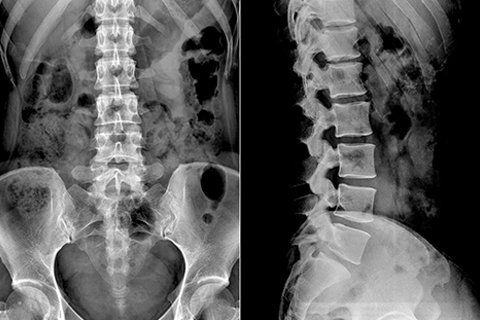 Foraminectomy