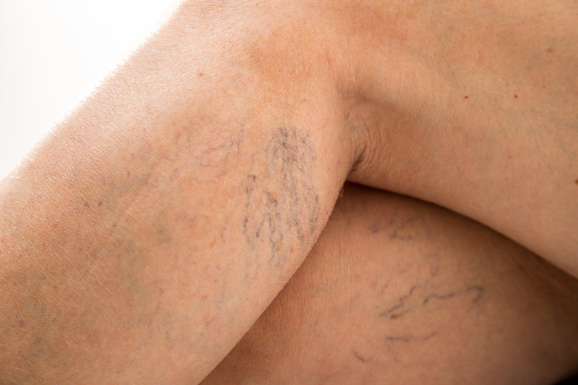 A close up of a person 's leg with varicose veins.