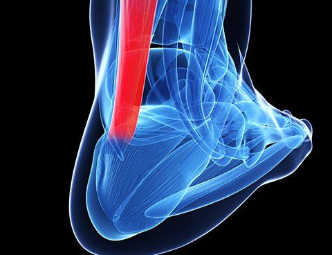 Achilles Tendinitis Achilles Tendinitis