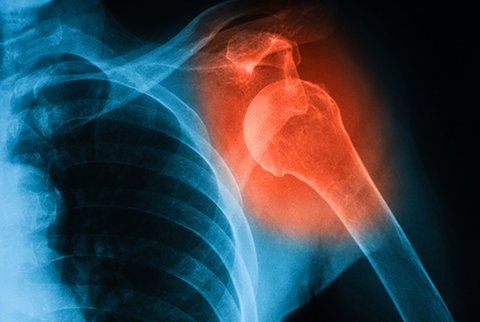 Dislocation Dislocation