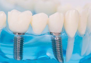 Crowns, veneers and bridges