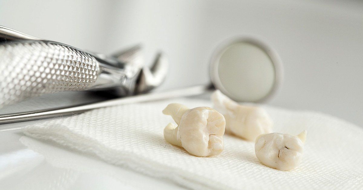 Wisdom Tooth Extraction