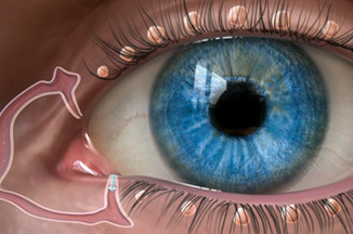 Punctal plugs for treating dry eye in Meridian and Boise ID 
