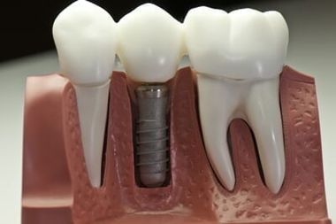 Implants Implants