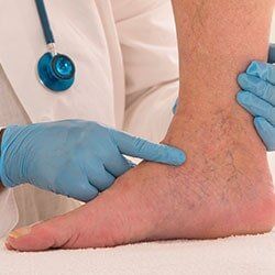 Vascular Surgery — Varicose Veins in Mission,TX Vascular Surgery — Varicose Veins in Mission,TX