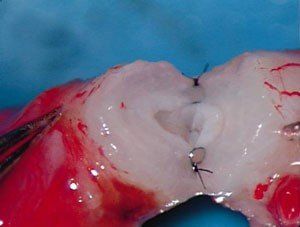 Vas deferens to be sealed by a Gold Coast urologist for vasectomy reversal