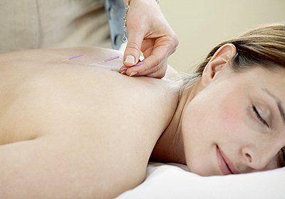 Modern acupuncture