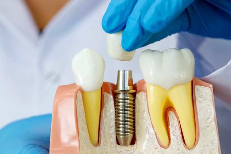 Model of Dental Implant offered at Transcend Dental Health