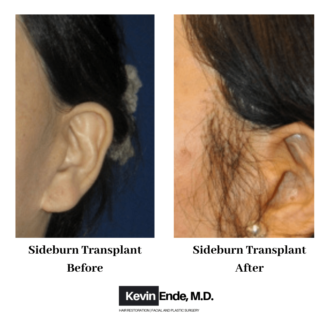 hair transplant