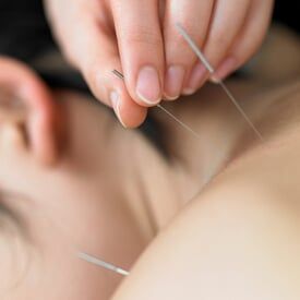 Acupuncture - Therapy in Millis, MA Acupuncture - Therapy in Millis, MA