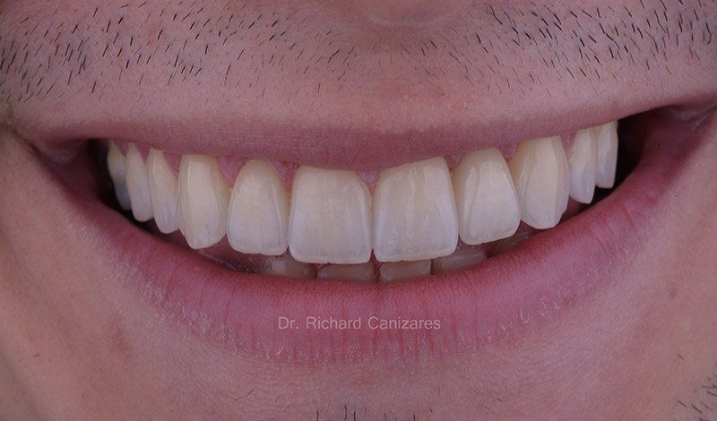 Carillas(Veneers) en cerámica