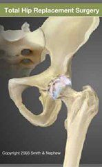 total hip surgery total hip surgery