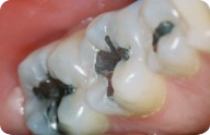 tooth