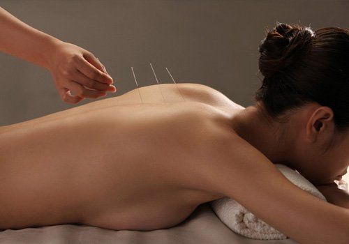 acupuncture