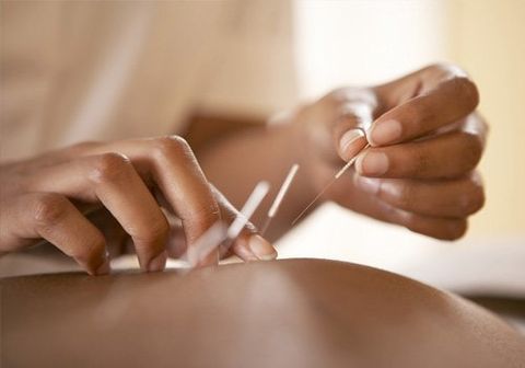 Acupuncture treatments