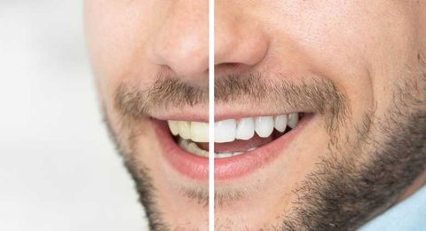 Teeth Whitening Procedure — St. Clair Shores, MI — Richard G. Raad, DDS, PC Teeth Whitening Procedure — St. Clair Shores, MI — Richard G. Raad, DDS, PC