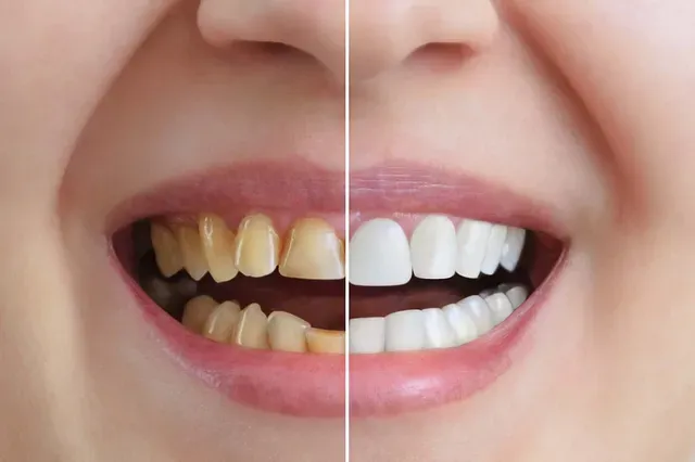 Before And After Of Teeth Whitening — St. Clair Shores, MI — Richard G. Raad, DDS, PC