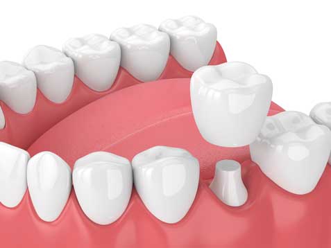 Dental Crown — St. Clair Shores, MI — Richard G. Raad, DDS, PC