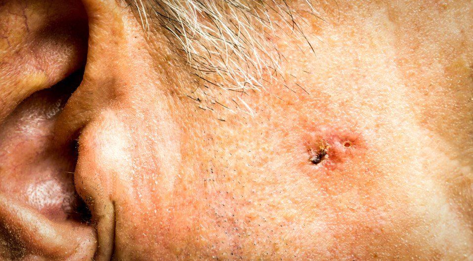Close-up of a skin lesion with a dark center on a person’s cheek near the ear