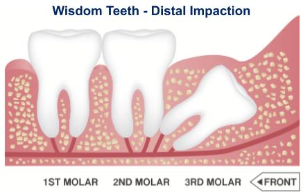 Distal Impaction