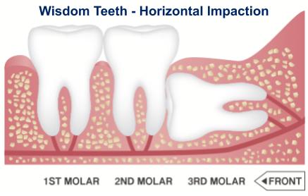 Horizontal Impaction