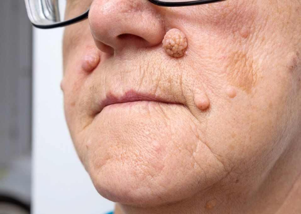 Close-up of a face with a raised wart-like skin growth near the upper lip and cheek.