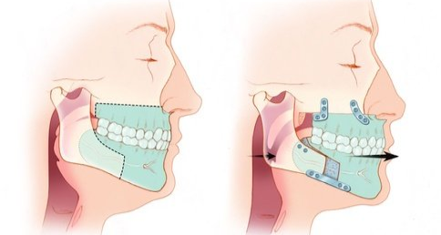 Side-view jaw diagrams showing a blue mouthguard/aligner fitted over teeth and jaw.