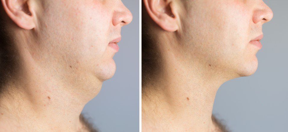 Side-by-side profile photos of a man’s neck and jawline, showing a double chin before and after.
